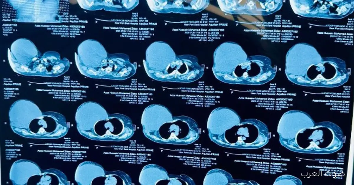 مريض يدفع 480 جنيه عشان يستأصل ورم وزنه 6 كيلو من جدار صدره في بورسعيد